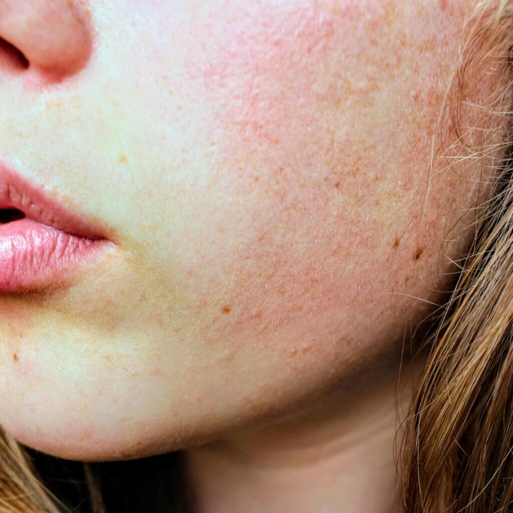 Close‑up of a person’s cheek, jawline and lips showing natural skin texture, freckles and mild redness.